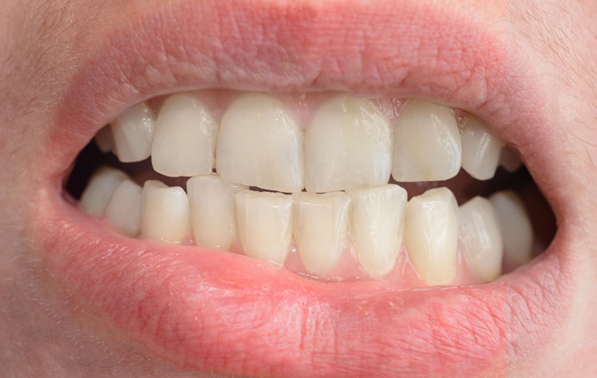 Além da estética dentes tortos podem afetar sua saúde